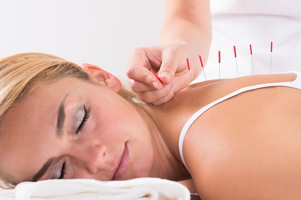 acupuncture therapy